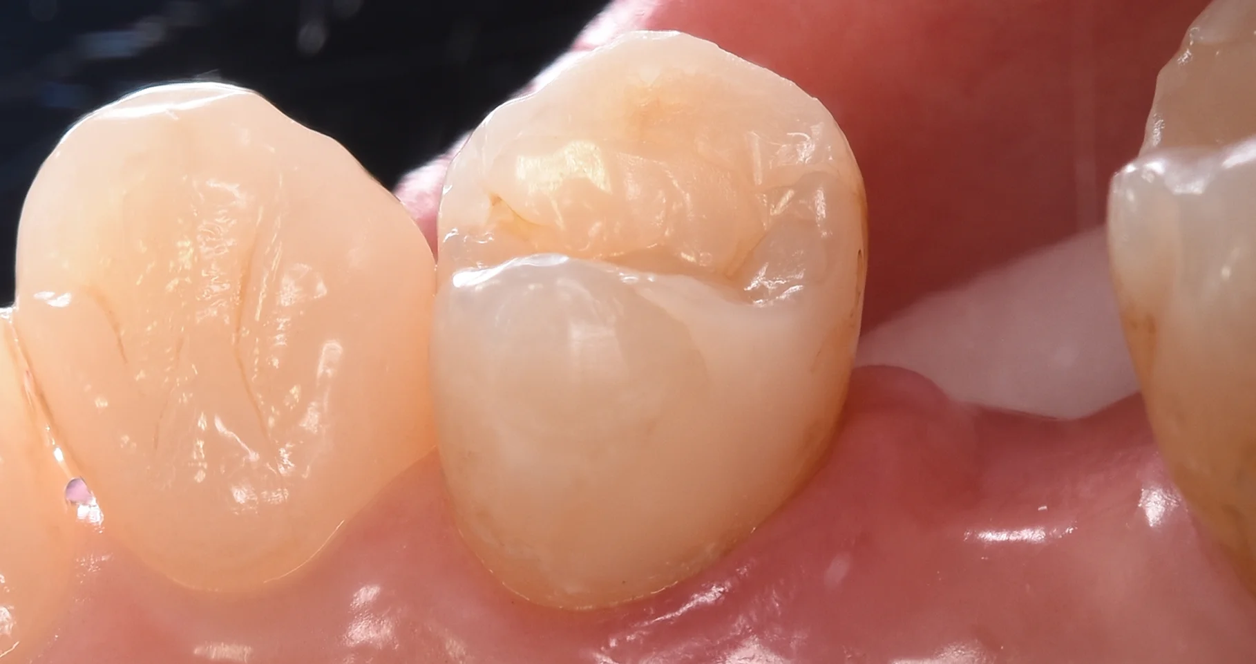 ダイレクトボンディング術後4年での補修修復|坂寄歯科医院(取手市藤代) - 画像5