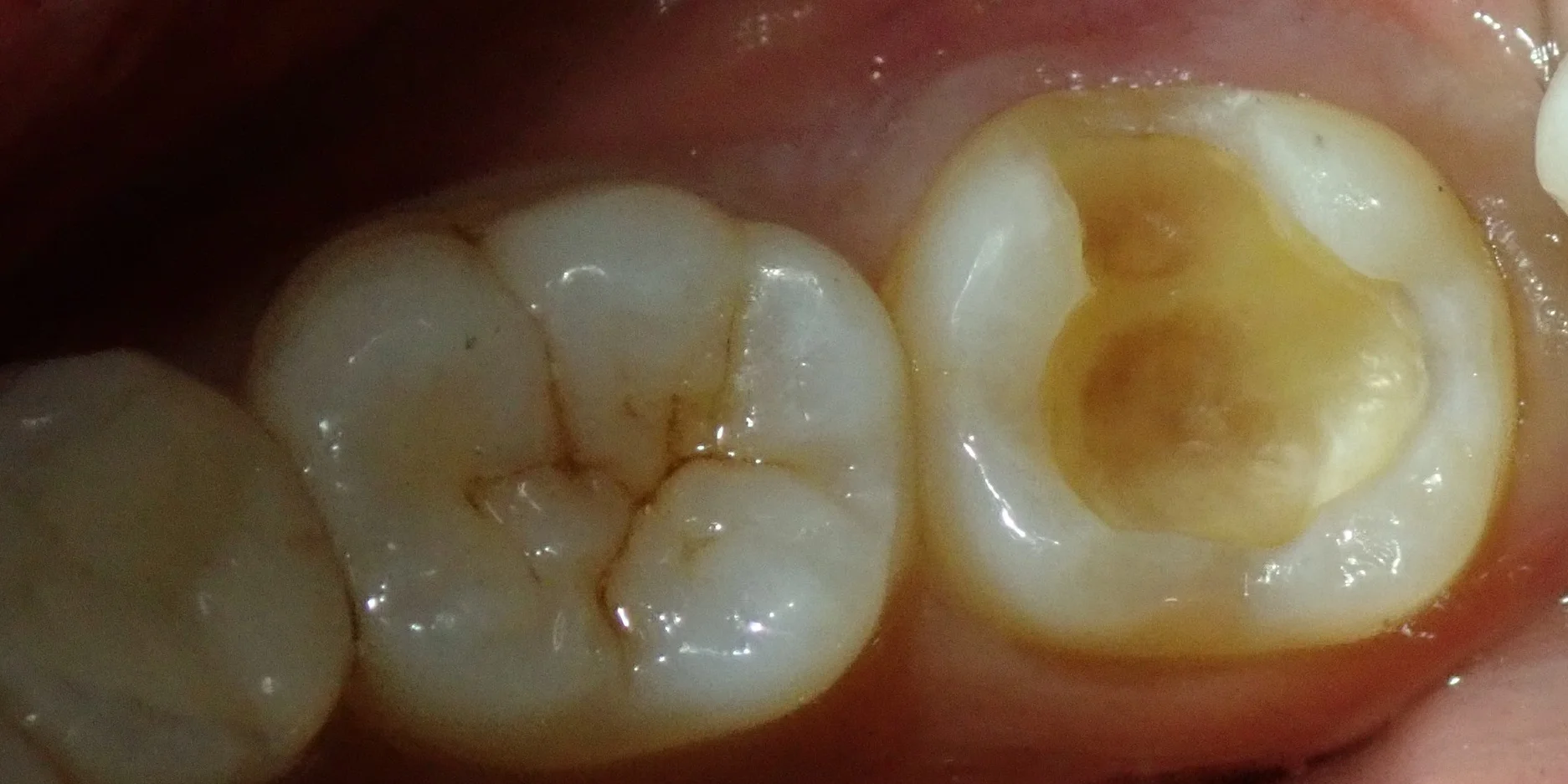 左下奥歯の白い詰め物｜坂寄歯科医院（取手市藤代） - 画像2