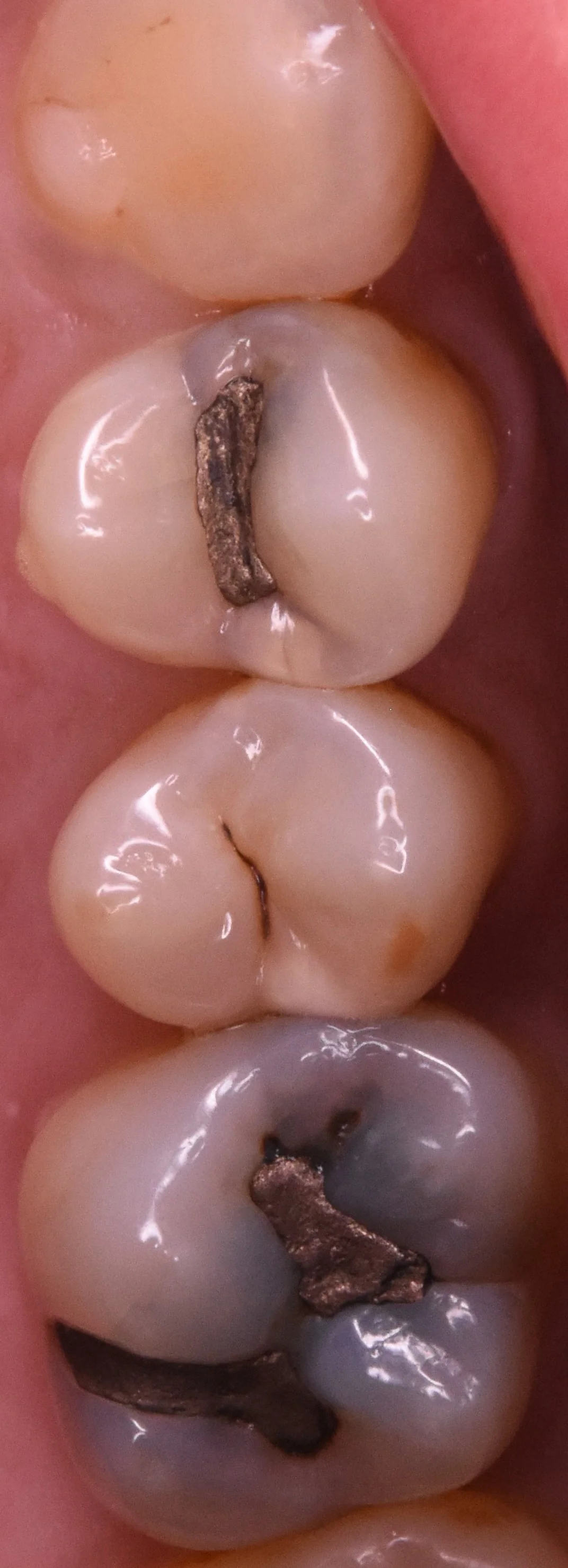 奥歯3本を纏めて一気に治療。|坂寄歯科医院(取手市藤代)