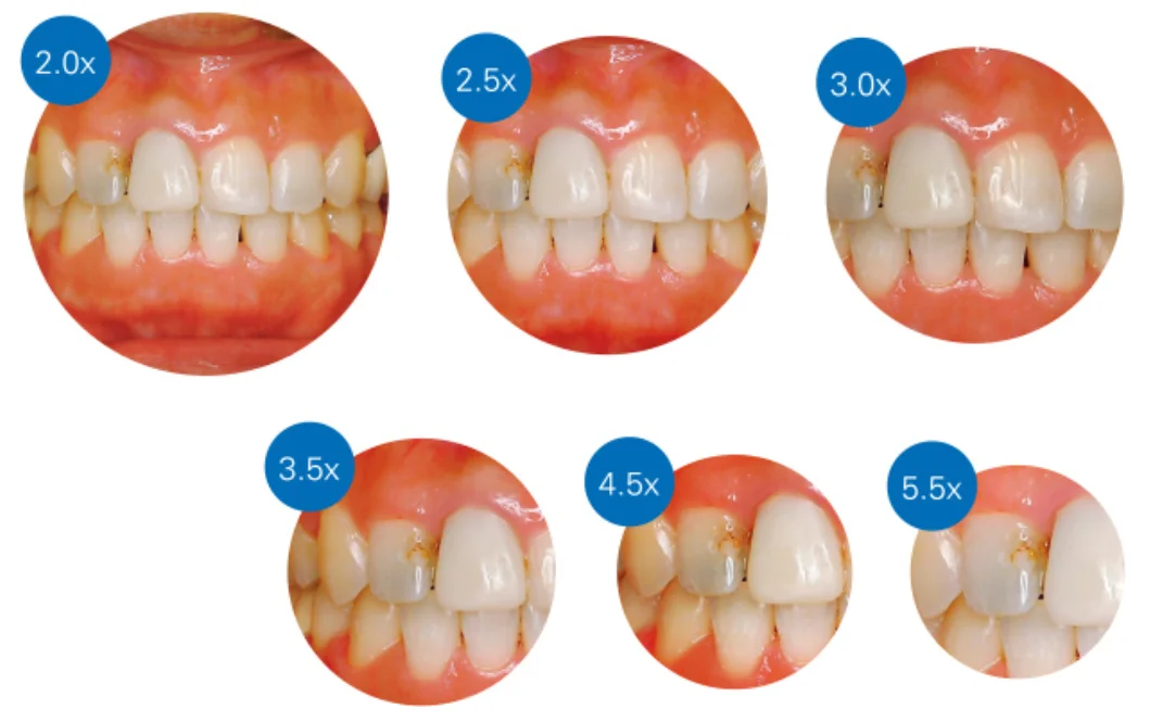拡大視野について｜坂寄歯科医院（取手市藤代）