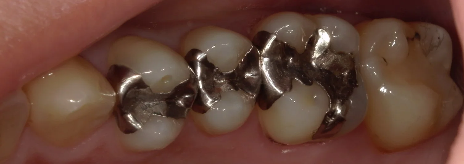 全体的に金属を白くしたいという方の治療｜坂寄歯科医院（取手市藤代）