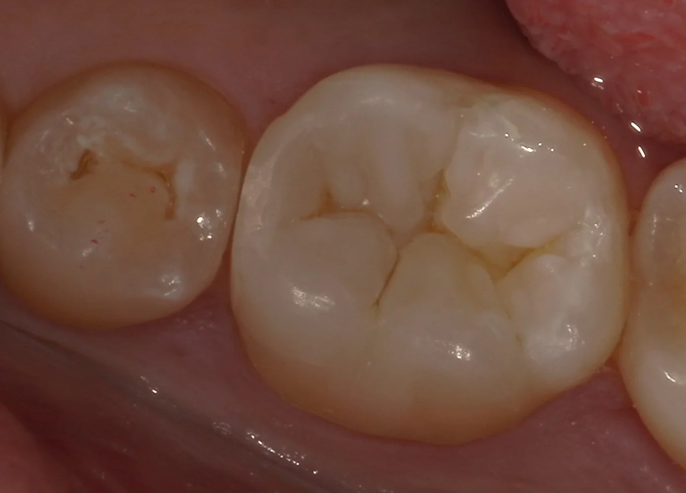 難易度の高い白い詰め物。|坂寄歯科医院(取手市藤代) - 画像5