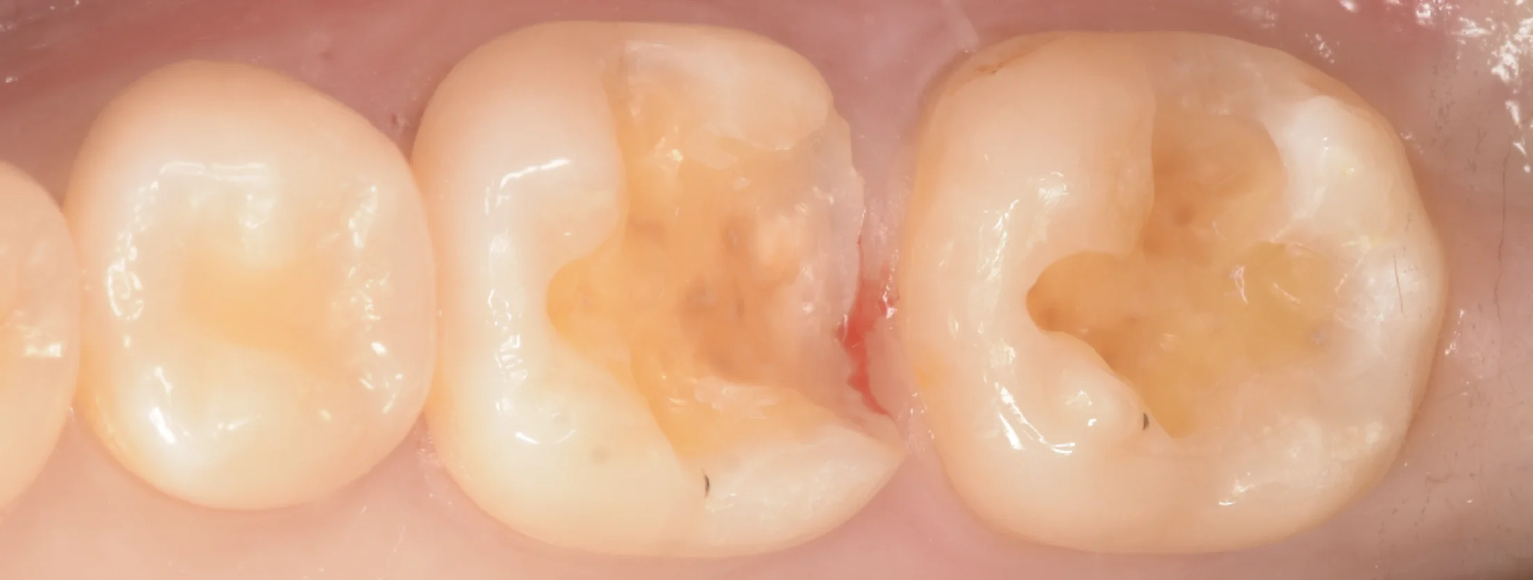 歯科医師の方のCAD/CAMインレーを治療。|坂寄歯科医院(取手市藤代) - 画像3