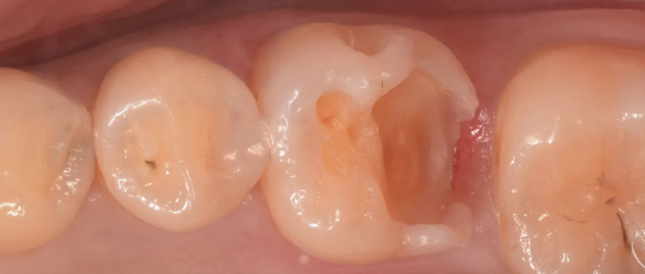 歯科医師の方のCAD/CAMインレーを治療。｜坂寄歯科医院（取手市藤代） - 画像3
