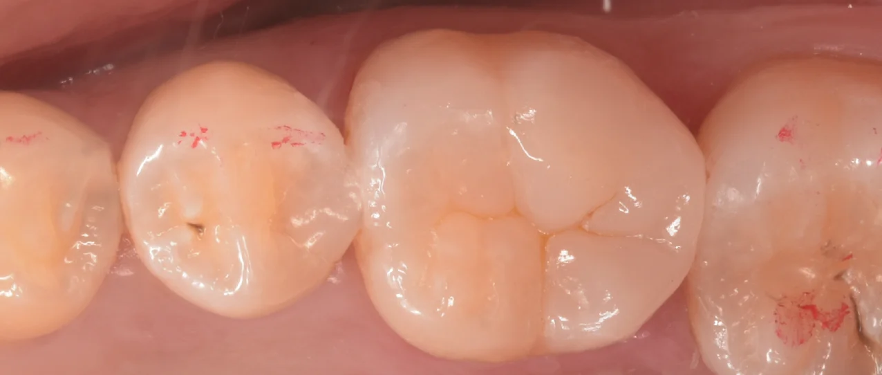 歯科医師の方のCAD/CAMインレーを治療。｜坂寄歯科医院（取手市藤代） - 画像4