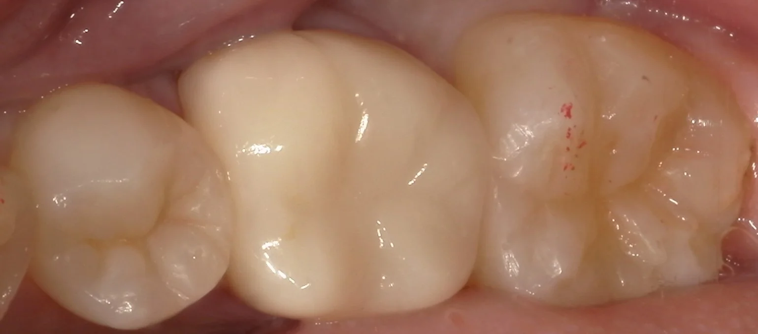 ワンデートリートメントを始めました。|坂寄歯科医院(取手市藤代) - 画像2