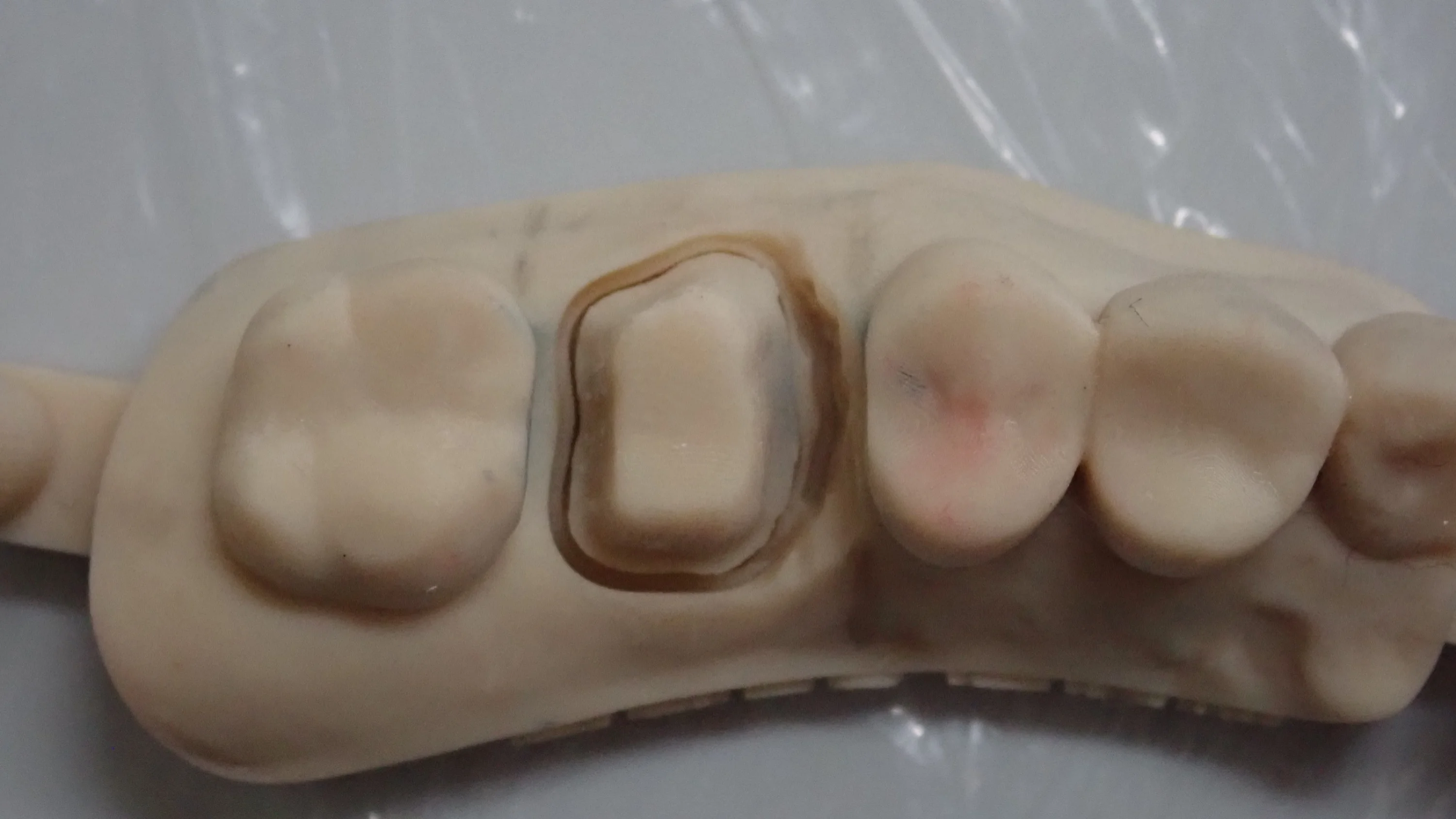 被せ物が無調整で入るとすっごく気持ちいい。|坂寄歯科医院(取手市藤代) - 画像2