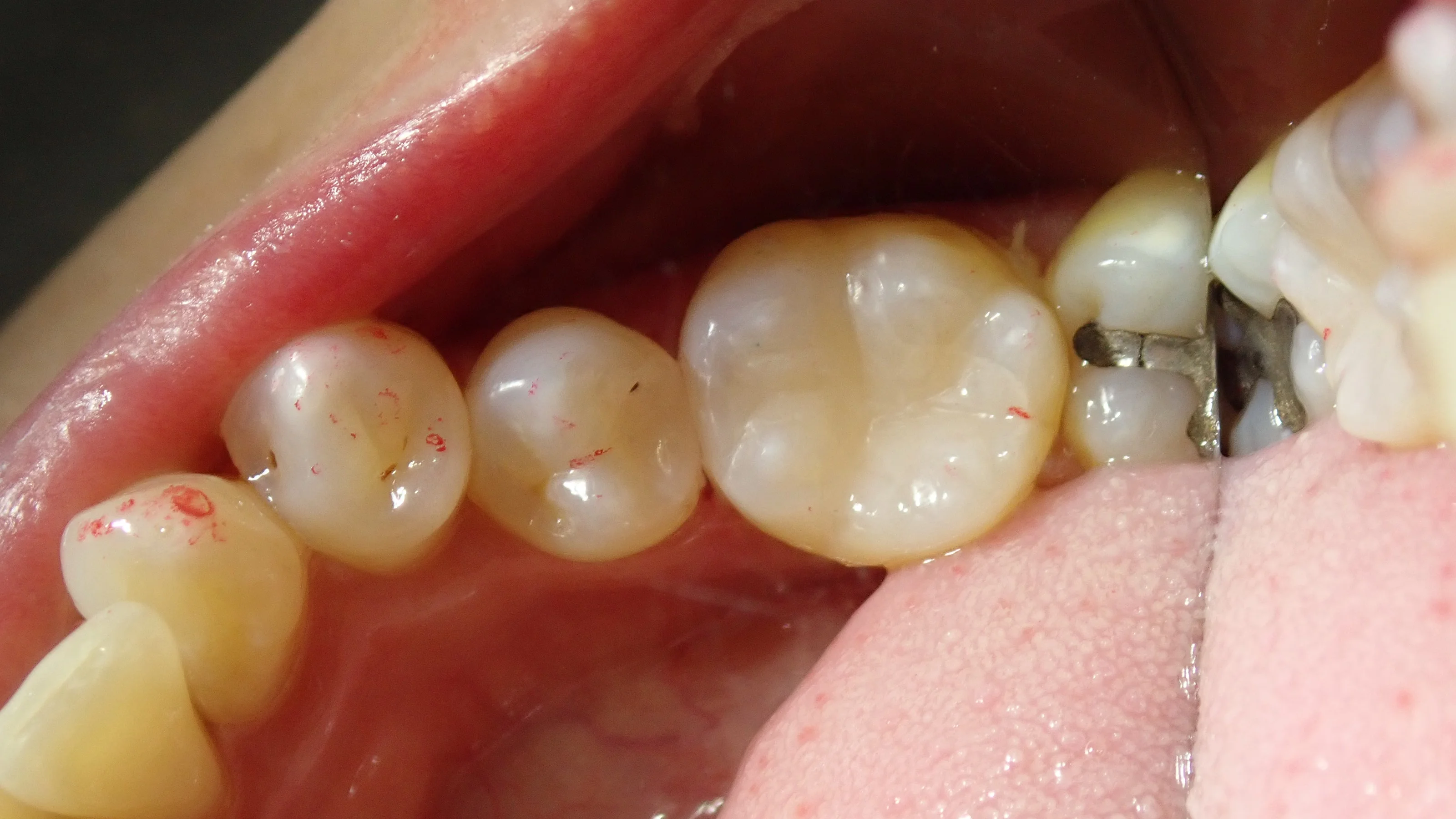 下の奥歯2本の詰め物|坂寄歯科医院(取手市藤代) - 画像4
