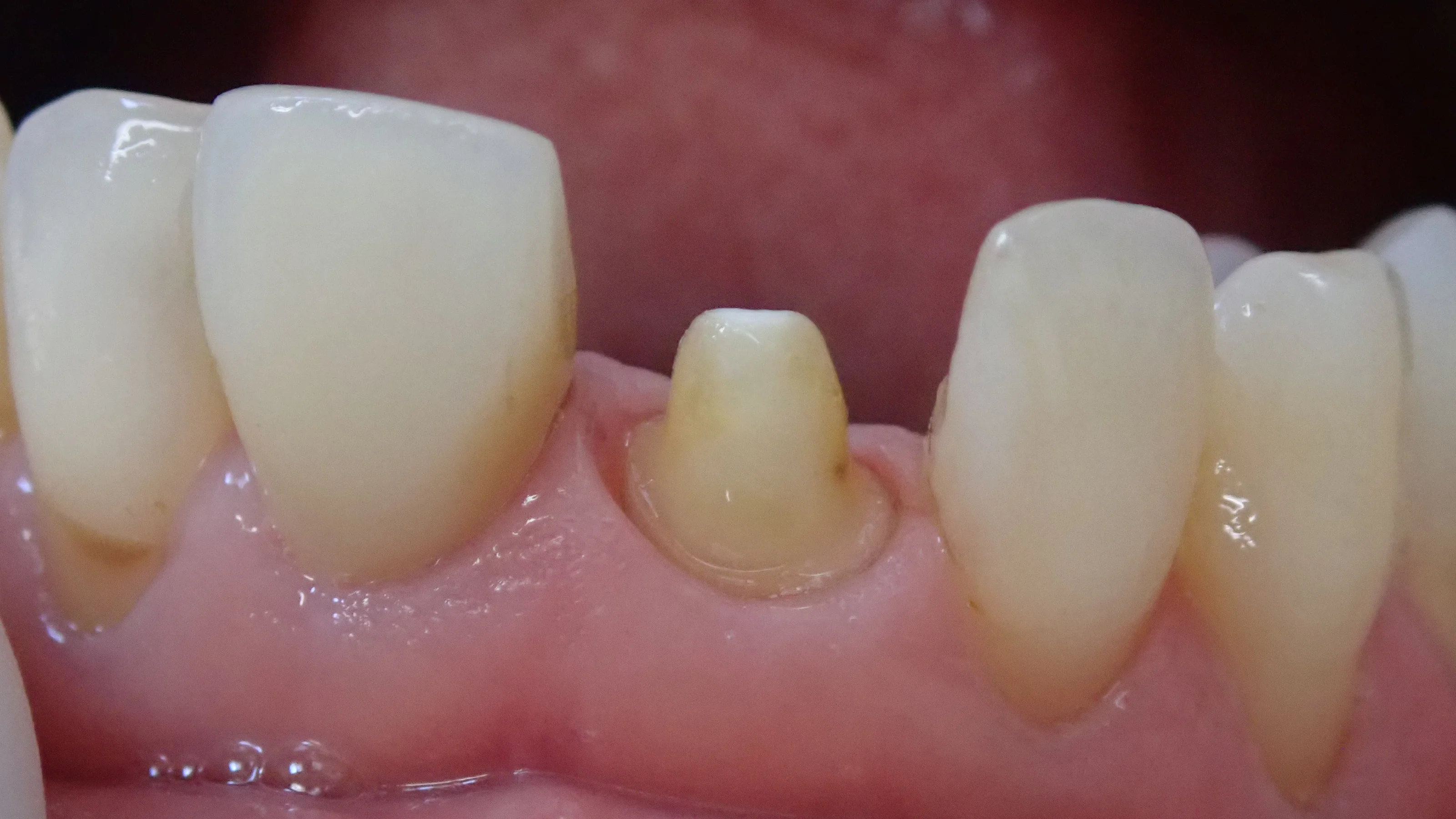 仮歯へのこだわり。その2|坂寄歯科医院(取手市藤代) - 画像2