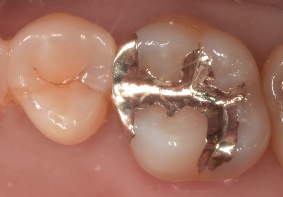 金属の詰め物を白い歯に。｜坂寄歯科医院（取手市藤代）