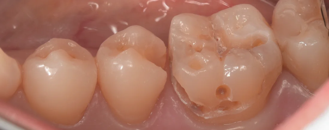 三鷹より来院された方|坂寄歯科医院(取手市藤代) - 画像4