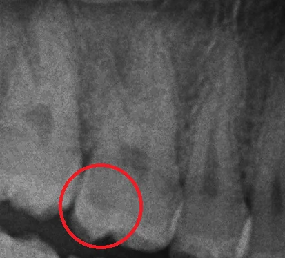 シールドレストレーション･･･？｜坂寄歯科医院（取手市藤代） - 画像2