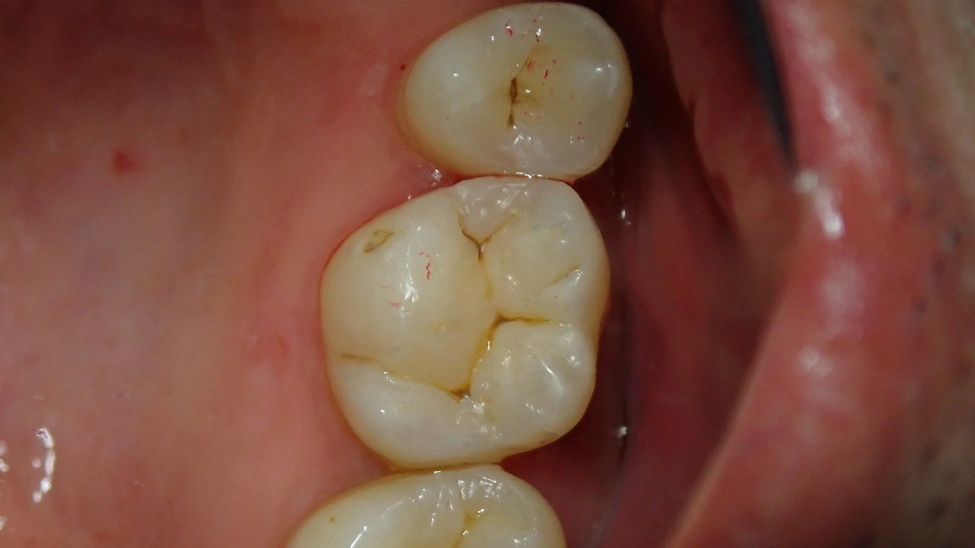 ダイレクトボンディング⑨|坂寄歯科医院(取手市藤代) - 画像4