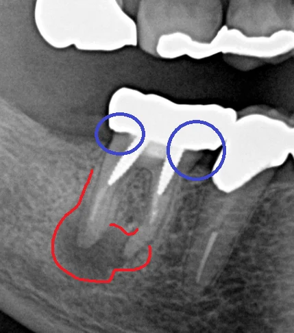 パーフォレーションリペア｜坂寄歯科医院（取手市藤代） - 画像2