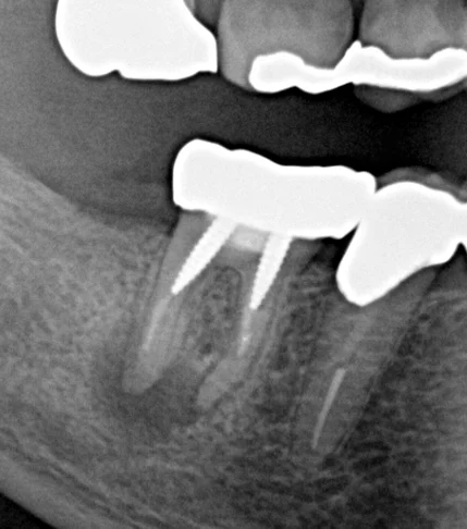 パーフォレーションリペア｜坂寄歯科医院（取手市藤代）