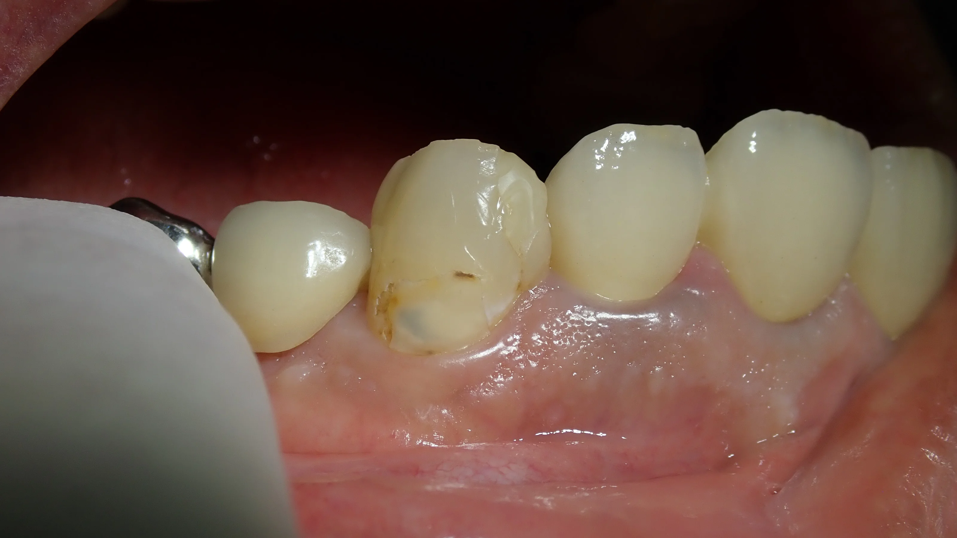 犬歯ダイレクトボンディング｜坂寄歯科医院（取手市藤代）