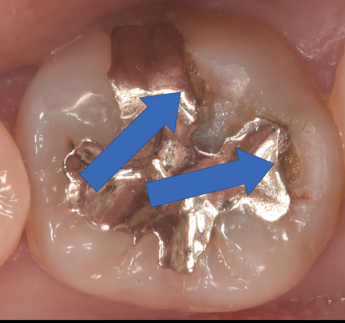 印西からお越しの方|坂寄歯科医院(取手市藤代) - 画像2