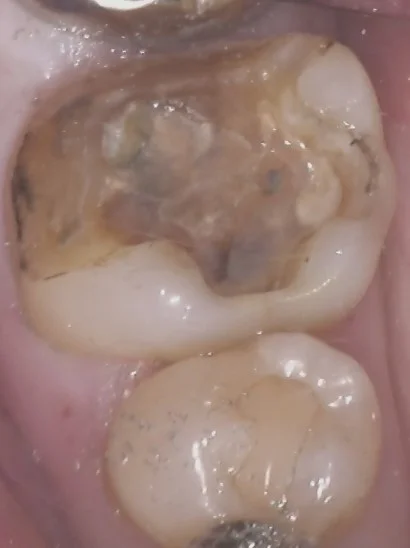 左下奥歯の白い詰め物｜坂寄歯科医院（取手市藤代） - 画像2