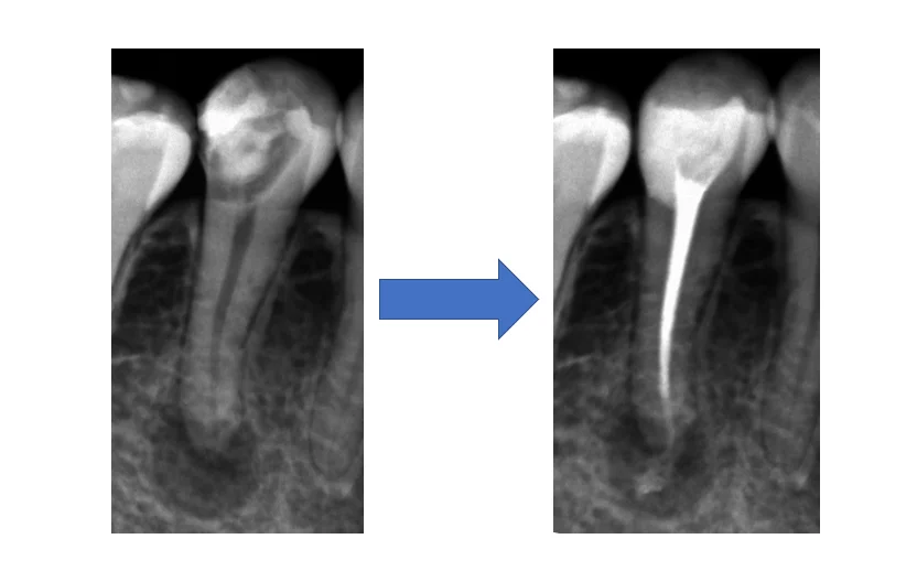 神経の治療③｜坂寄歯科医院（取手市藤代） - 画像3