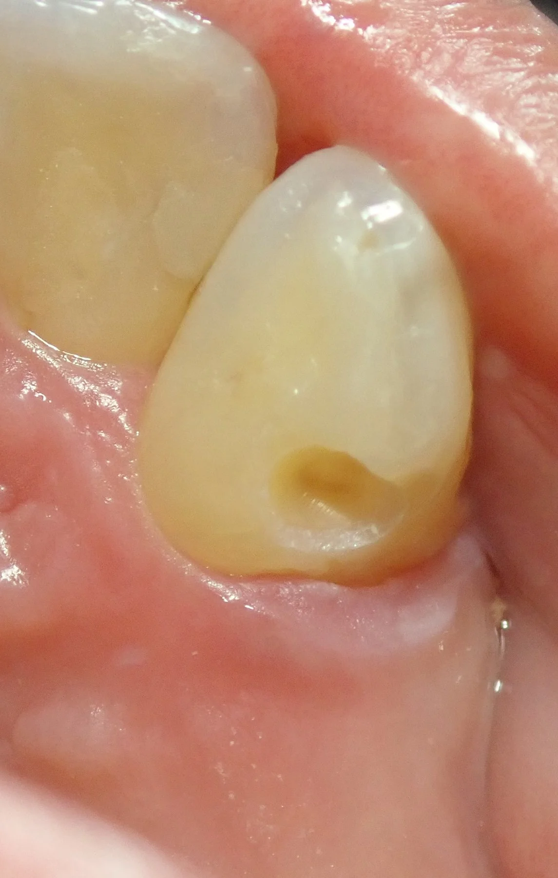 右上犬歯の白い詰め物｜坂寄歯科医院（取手市藤代） - 画像5