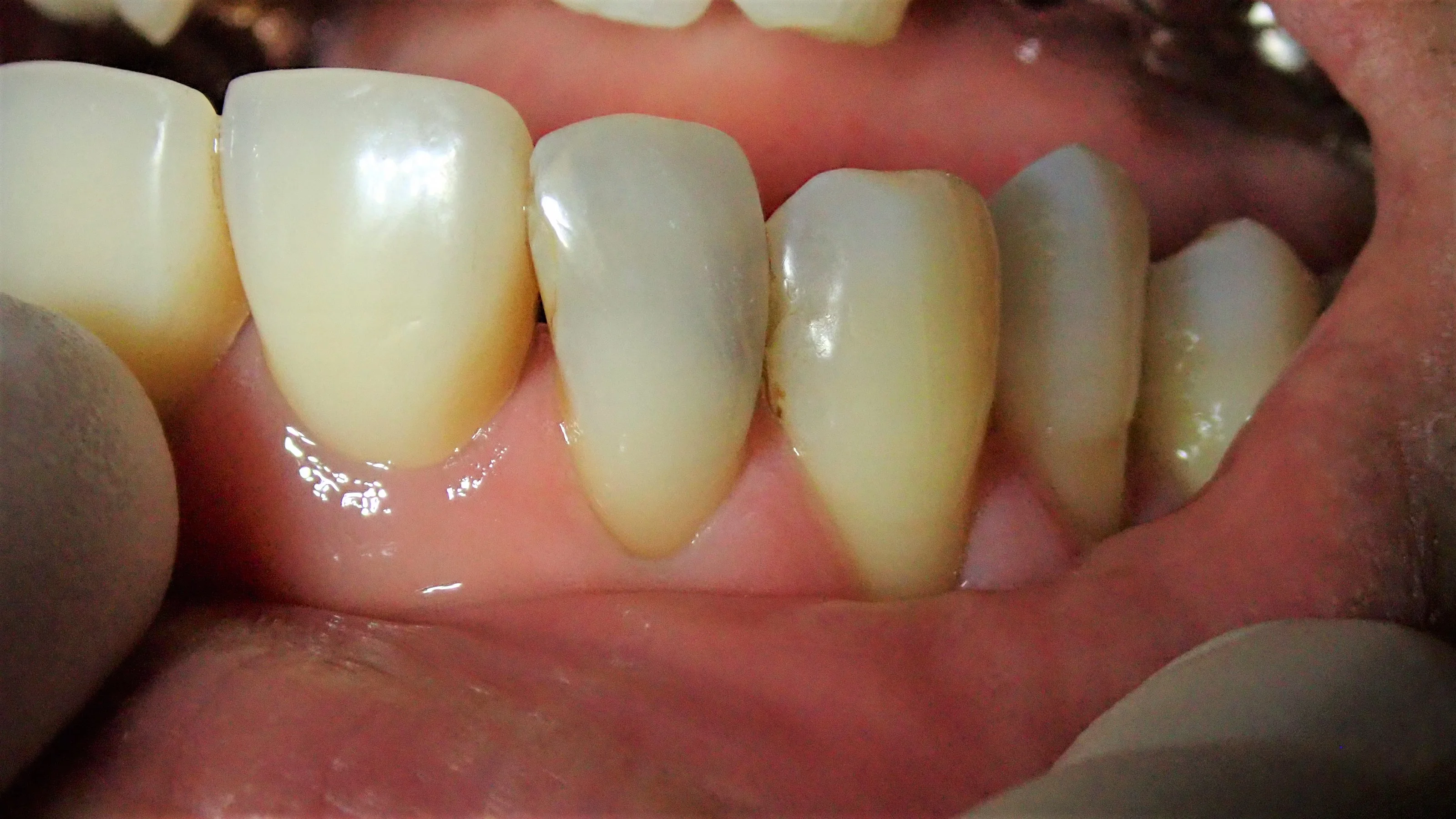 前歯ダイレクトボンディング｜坂寄歯科医院（取手市藤代）