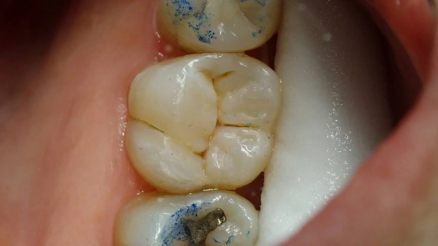 ダイレクトボンディング⑥｜坂寄歯科医院（取手市藤代） - 画像2