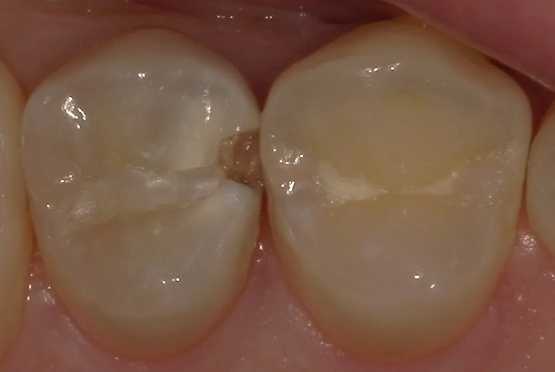 歯科医師の方の虫歯治療。|坂寄歯科医院(取手市藤代)