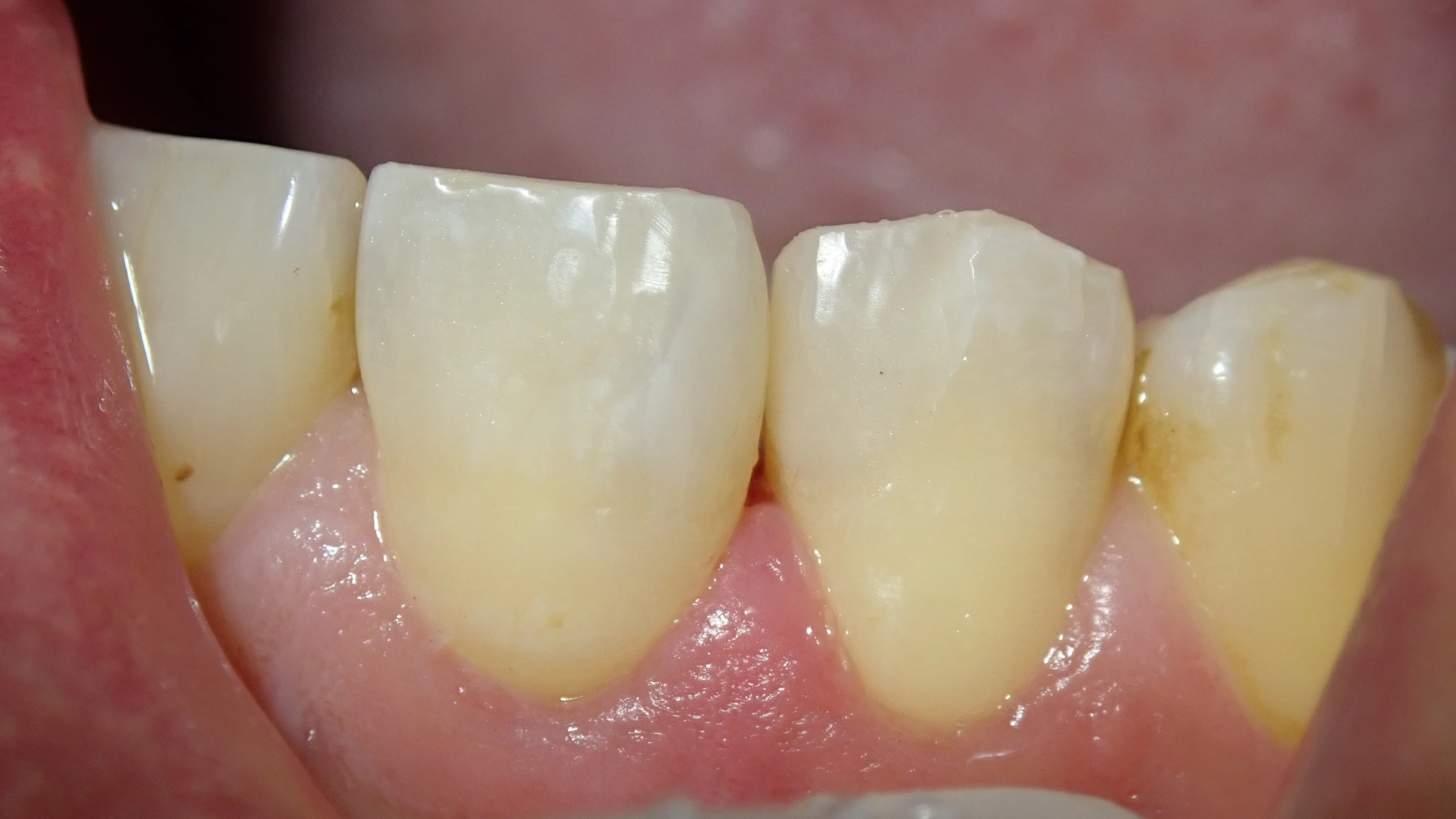 前歯の白い詰め物｜坂寄歯科医院（取手市藤代） - 画像7