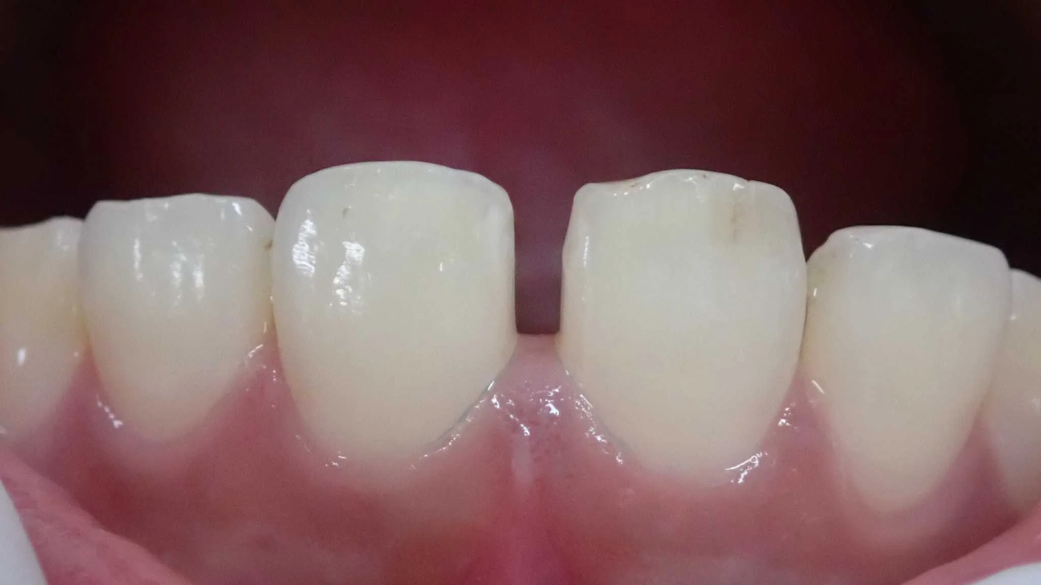 正中離開(すきっ歯)の治療|坂寄歯科医院(取手市藤代)