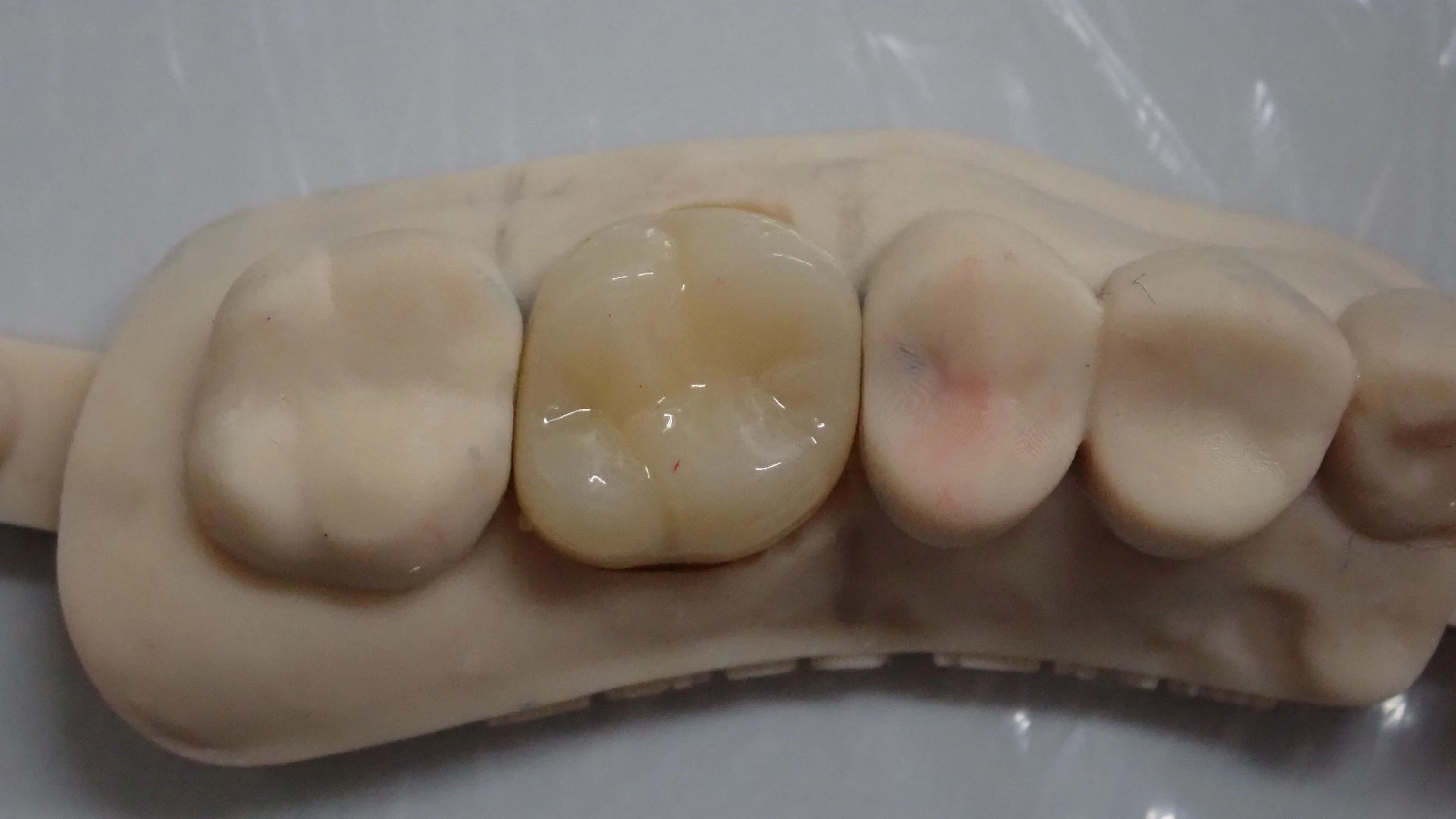 被せ物が無調整で入るとすっごく気持ちいい。|坂寄歯科医院(取手市藤代)