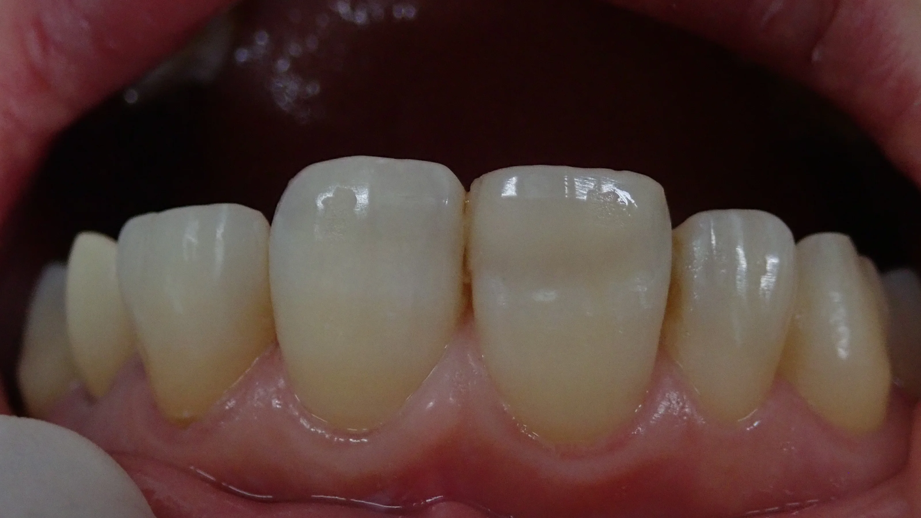 前歯ダイレクトボンディング②|坂寄歯科医院(取手市藤代) - 画像4