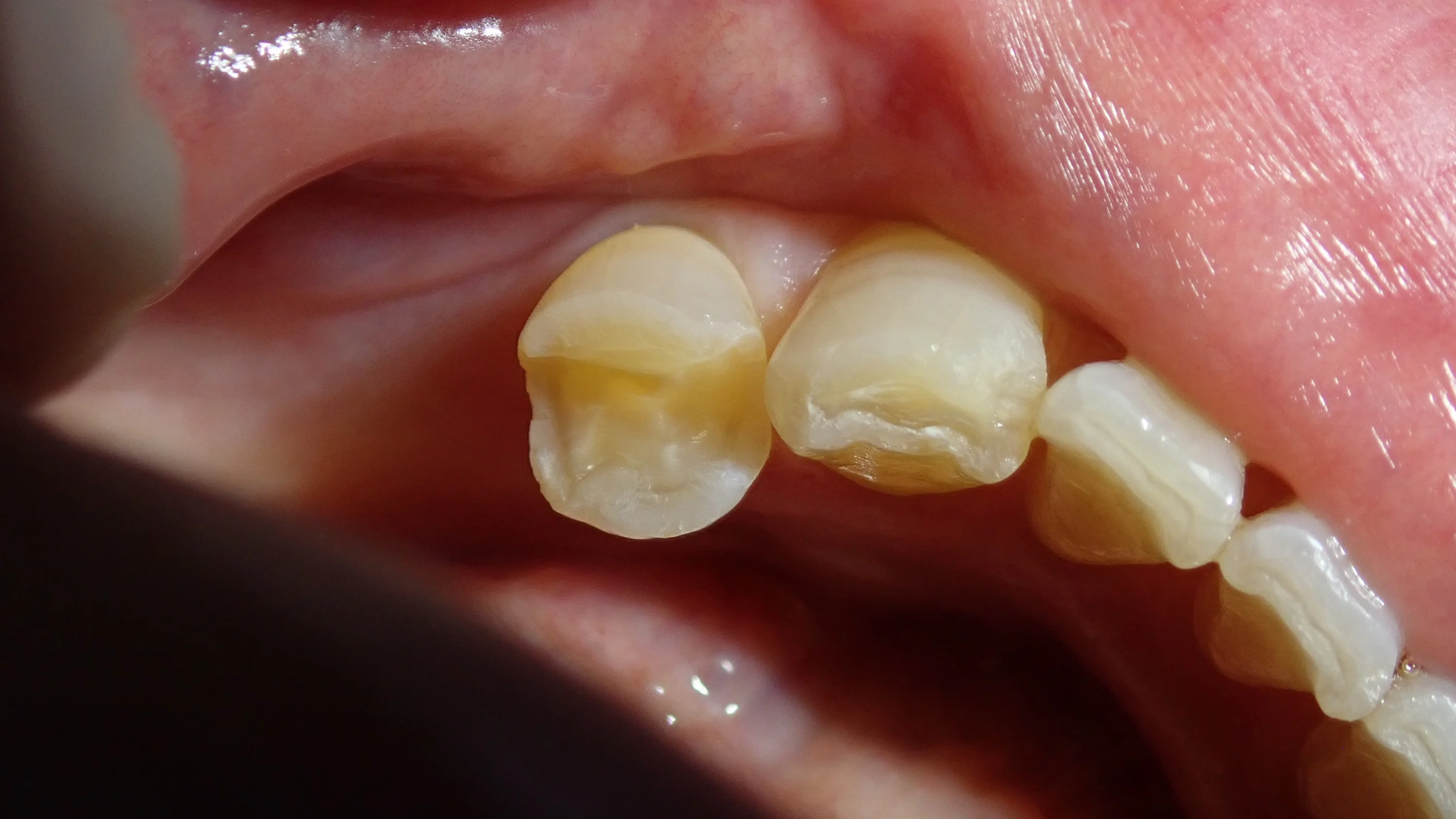 左下奥歯白い詰め物｜坂寄歯科医院（取手市藤代）