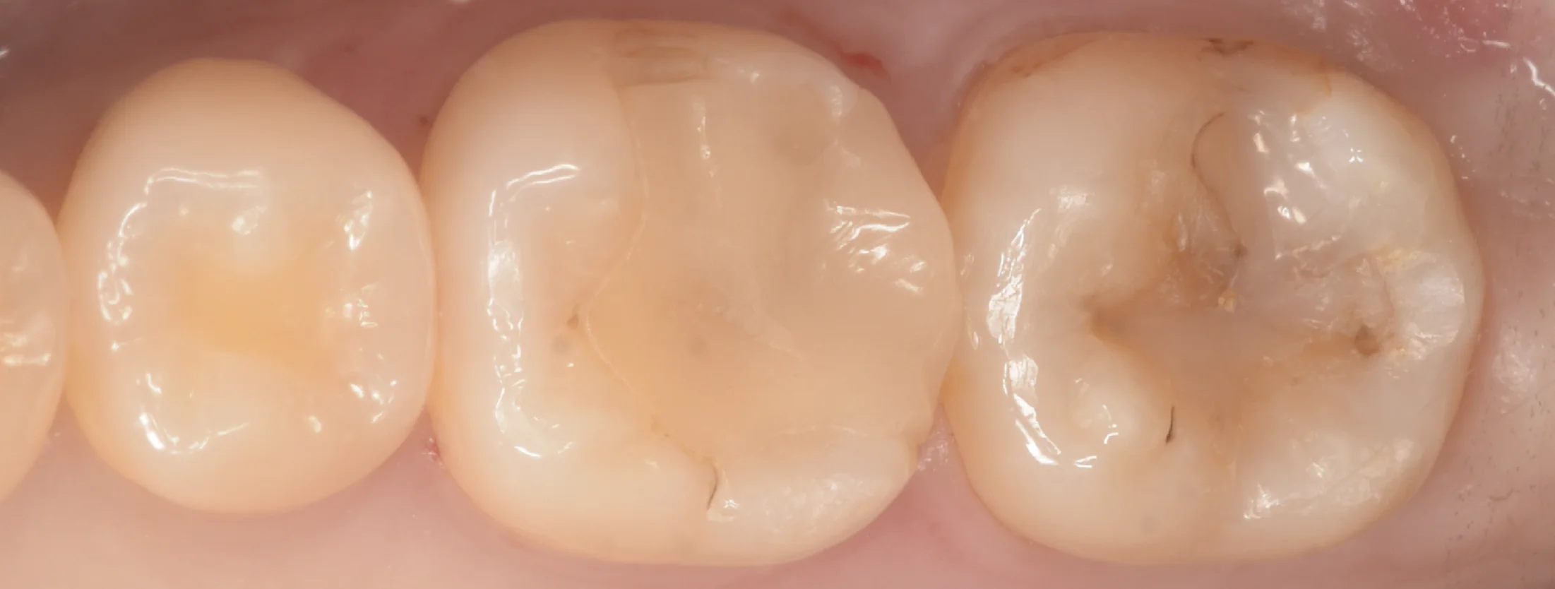 歯科医師の方のCAD/CAMインレーを治療。|坂寄歯科医院(取手市藤代)