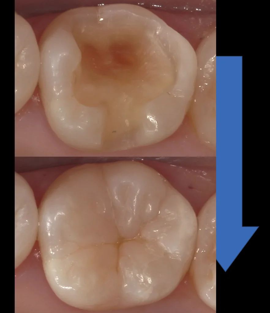 ダイレクトボンディングの長期経過｜坂寄歯科医院（取手市藤代）