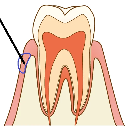 Q&A ~麻酔をしても痛いのはなぜ?~|坂寄歯科医院(取手市藤代)