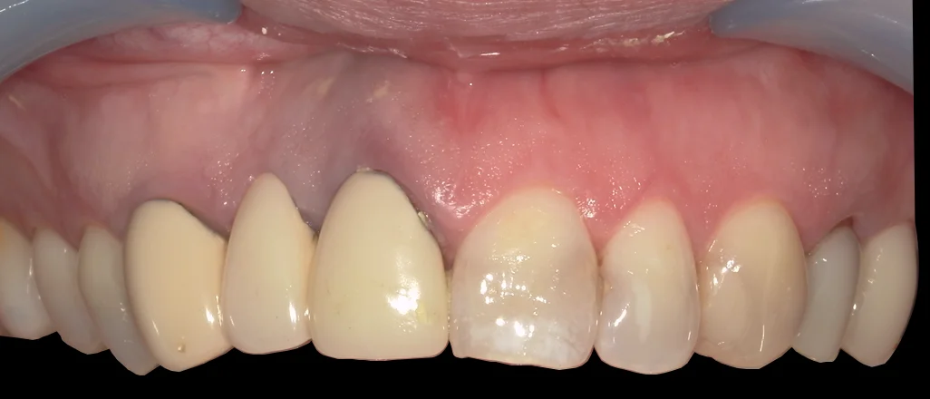 審美治療：セラミック｜坂寄歯科医院（取手市藤代）