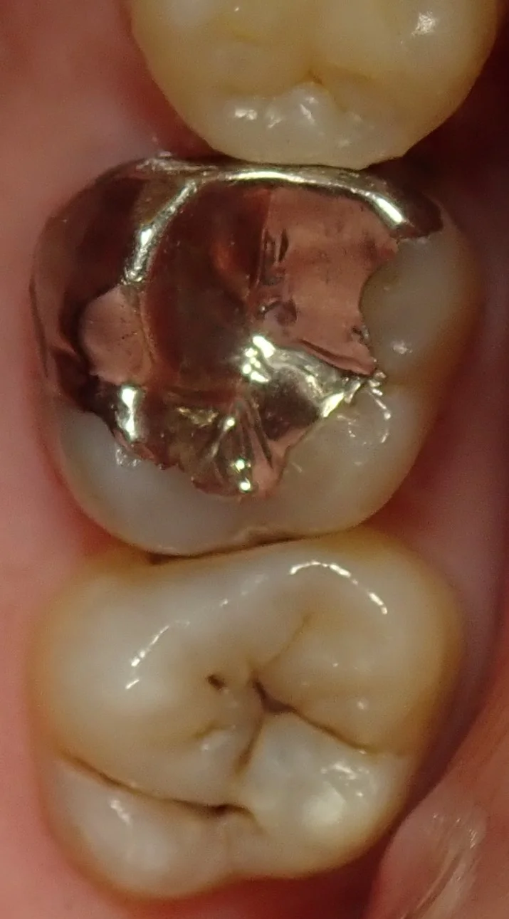 左上奥歯の白い詰め物|坂寄歯科医院(取手市藤代)