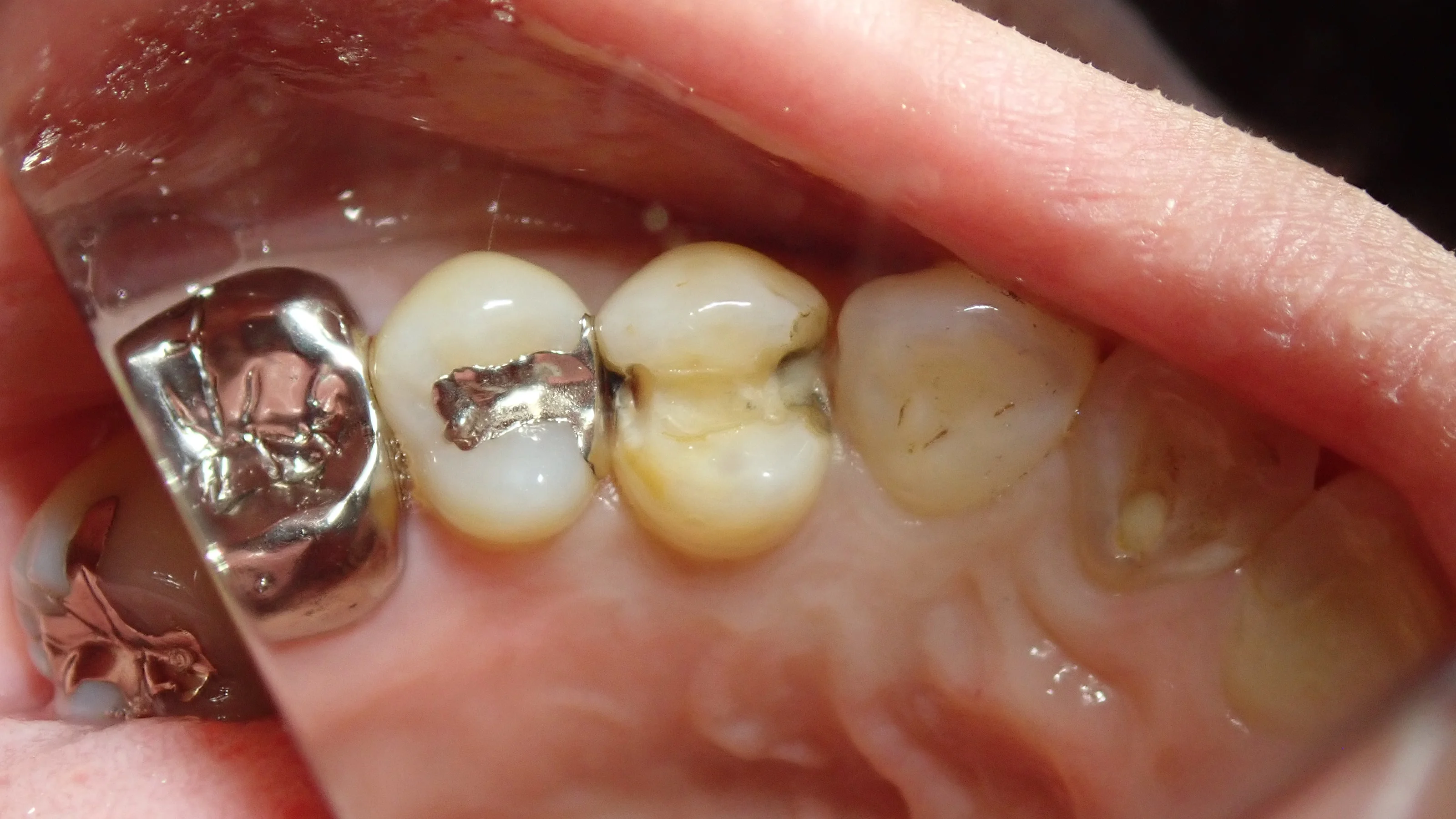 小さい奥歯(小臼歯)の白い詰め物|坂寄歯科医院(取手市藤代) - 画像3