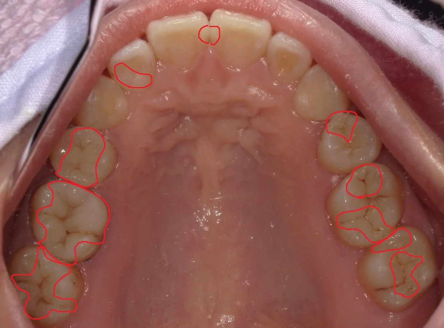 全体的に自費の白い詰め物で治したケース。｜坂寄歯科医院（取手市藤代） - 画像3