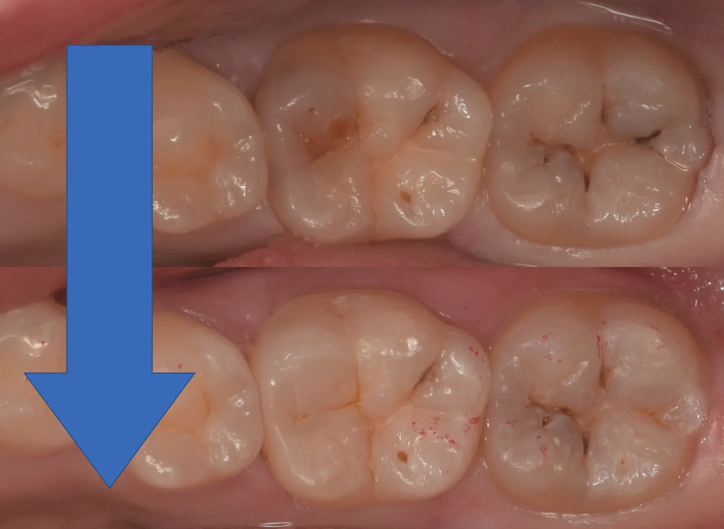 浦安から来た方をダイレクトボンディングで。｜坂寄歯科医院（取手市藤代） - 画像6