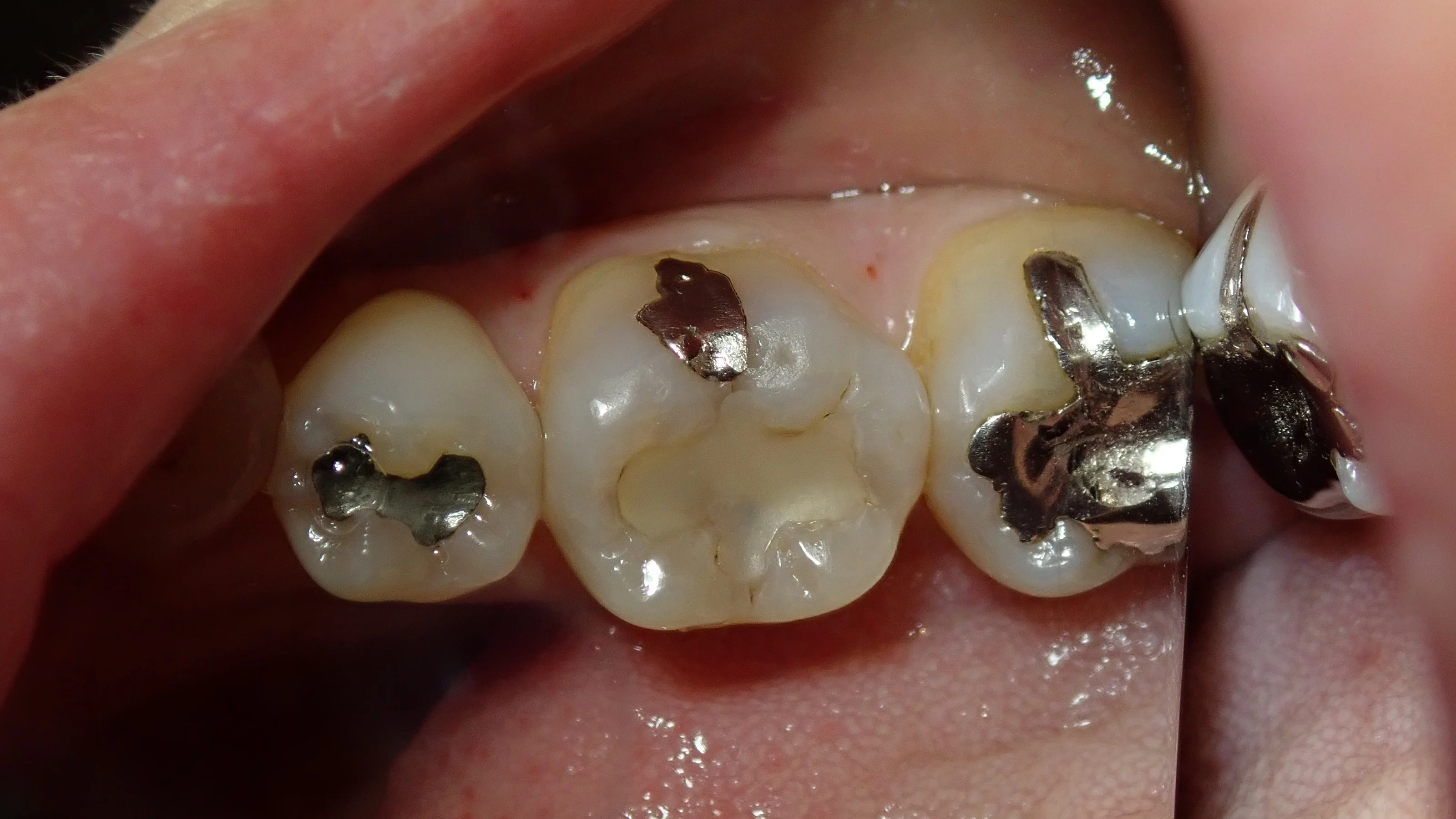 コンポジットレジン|坂寄歯科医院(取手市藤代)