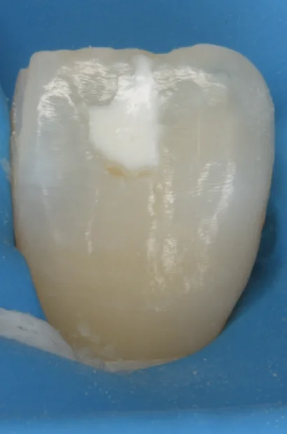 ICON治療にて改善しきらなかったケース。｜坂寄歯科医院（取手市藤代）