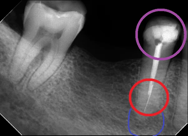レジンでは無理ですって！｜坂寄歯科医院（取手市藤代）