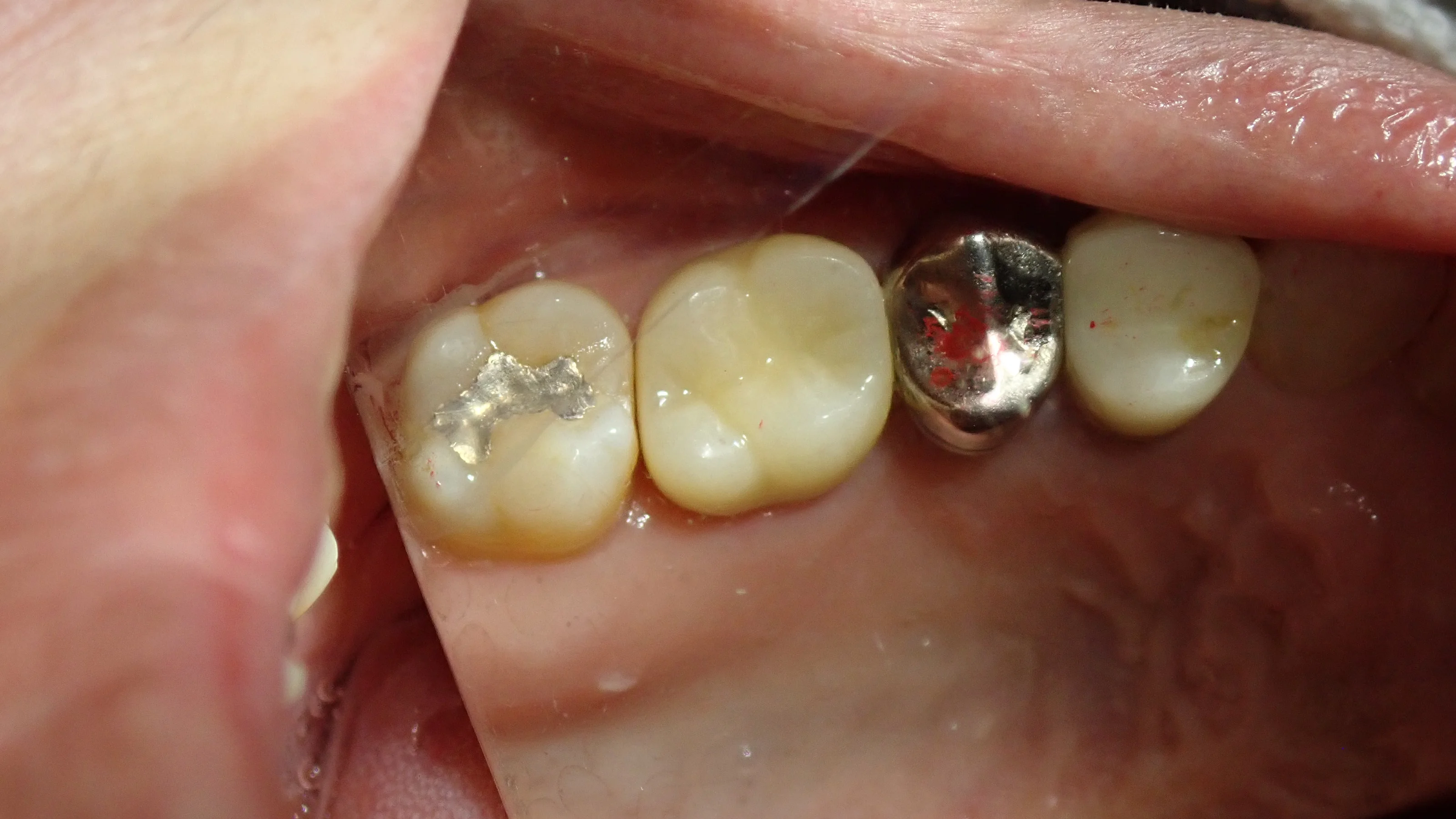 被せ物が無調整で入るとすっごく気持ちいい。|坂寄歯科医院(取手市藤代) - 画像4