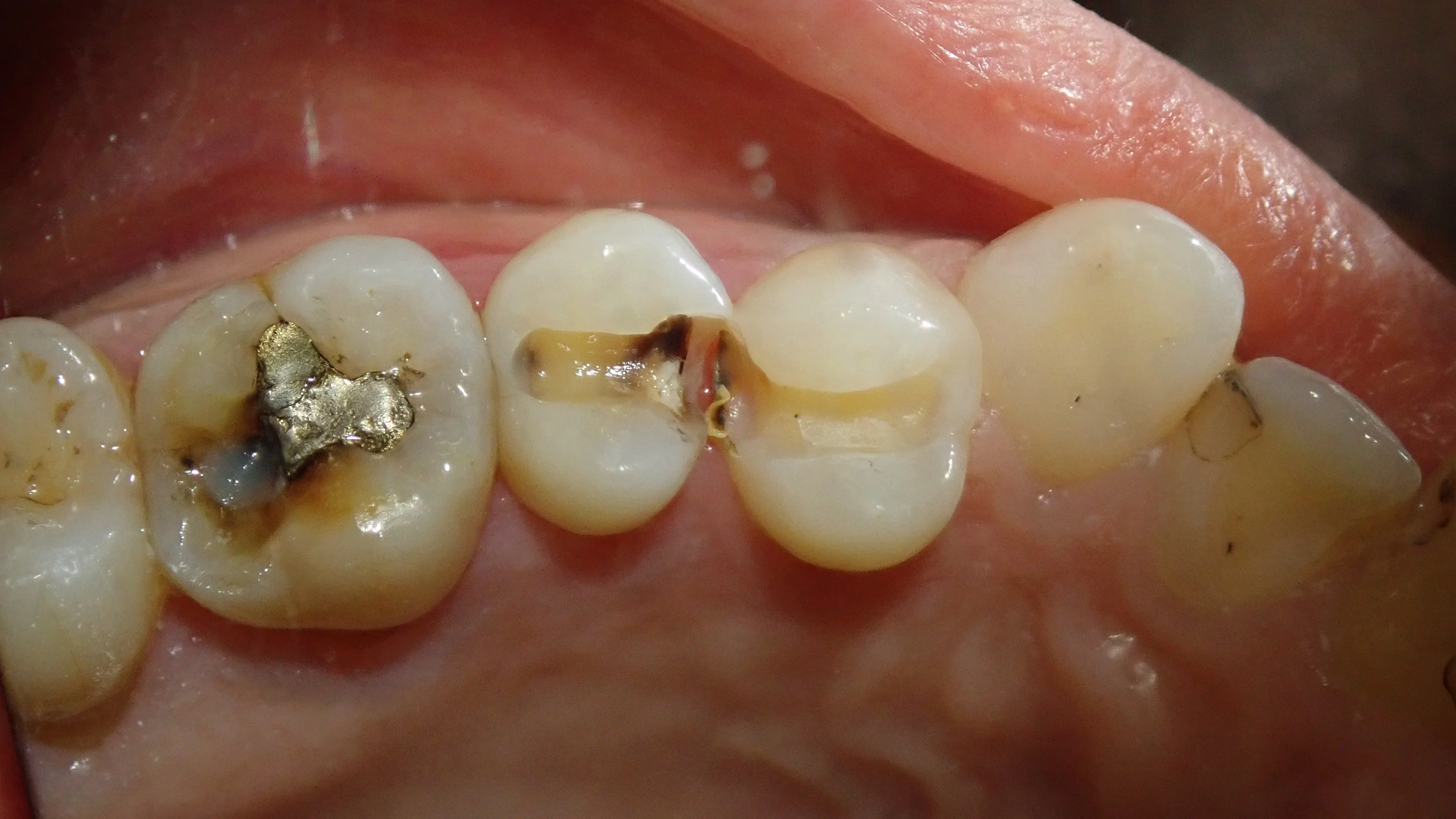 白い部分的な詰め物｜坂寄歯科医院（取手市藤代） - 画像3