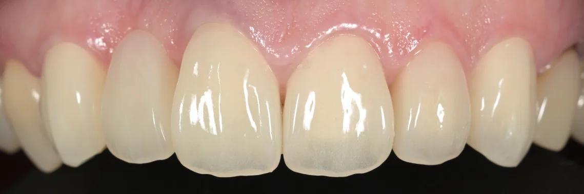審美治療：セラミック｜坂寄歯科医院（取手市藤代） - 画像2