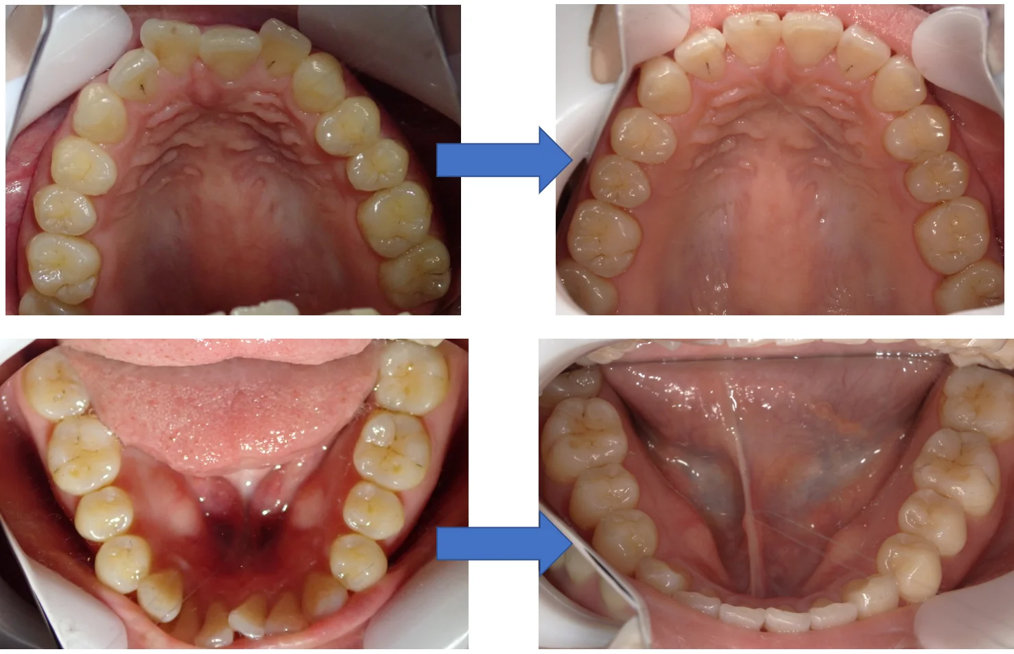 インビザライン矯正の術前術後|坂寄歯科医院(取手市藤代)