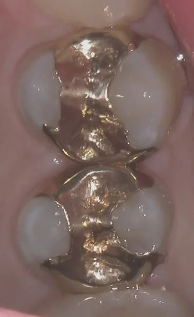 右上小さい奥歯の白い詰め物｜坂寄歯科医院（取手市藤代）