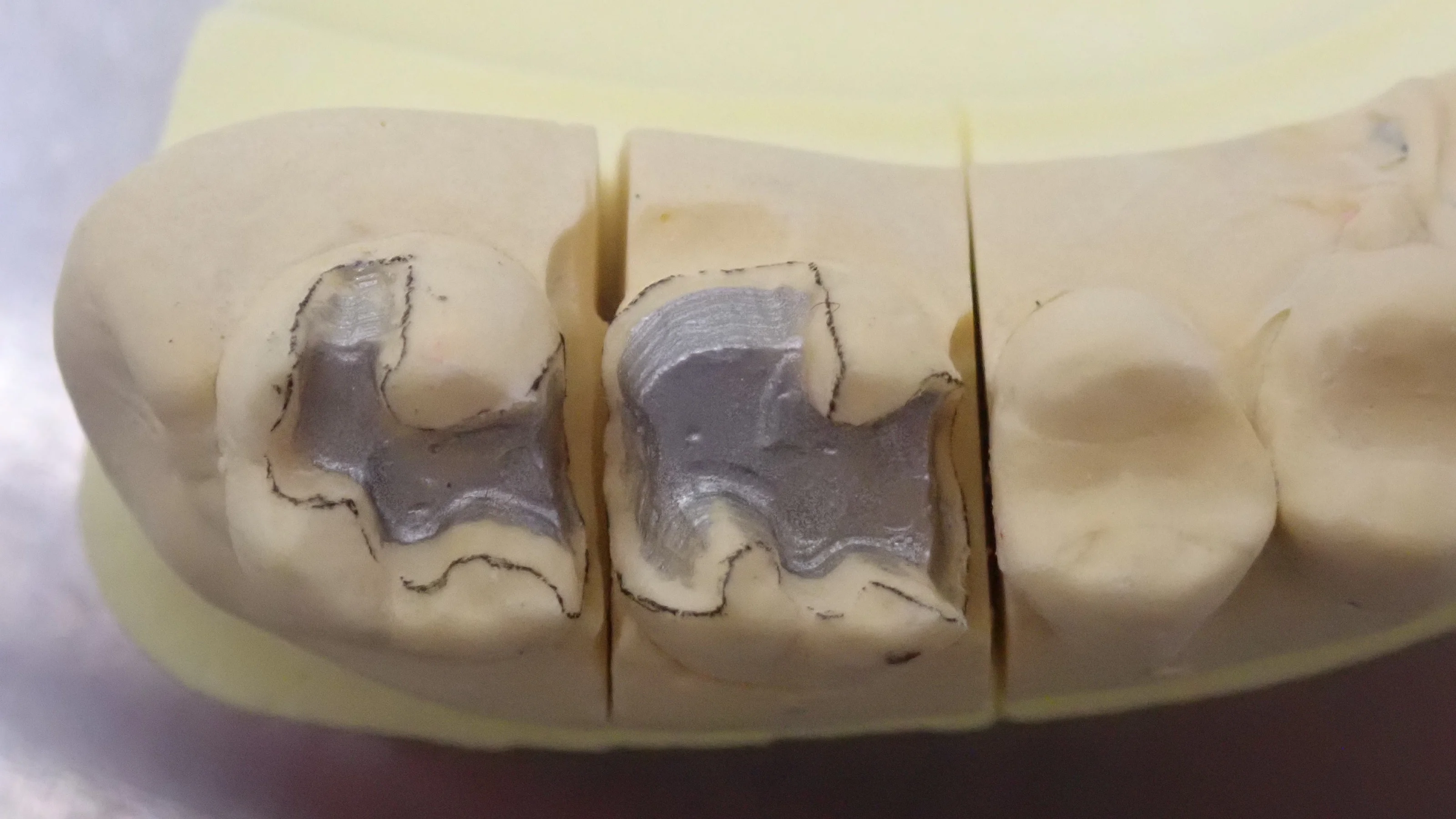 メタルインレー｜坂寄歯科医院（取手市藤代）