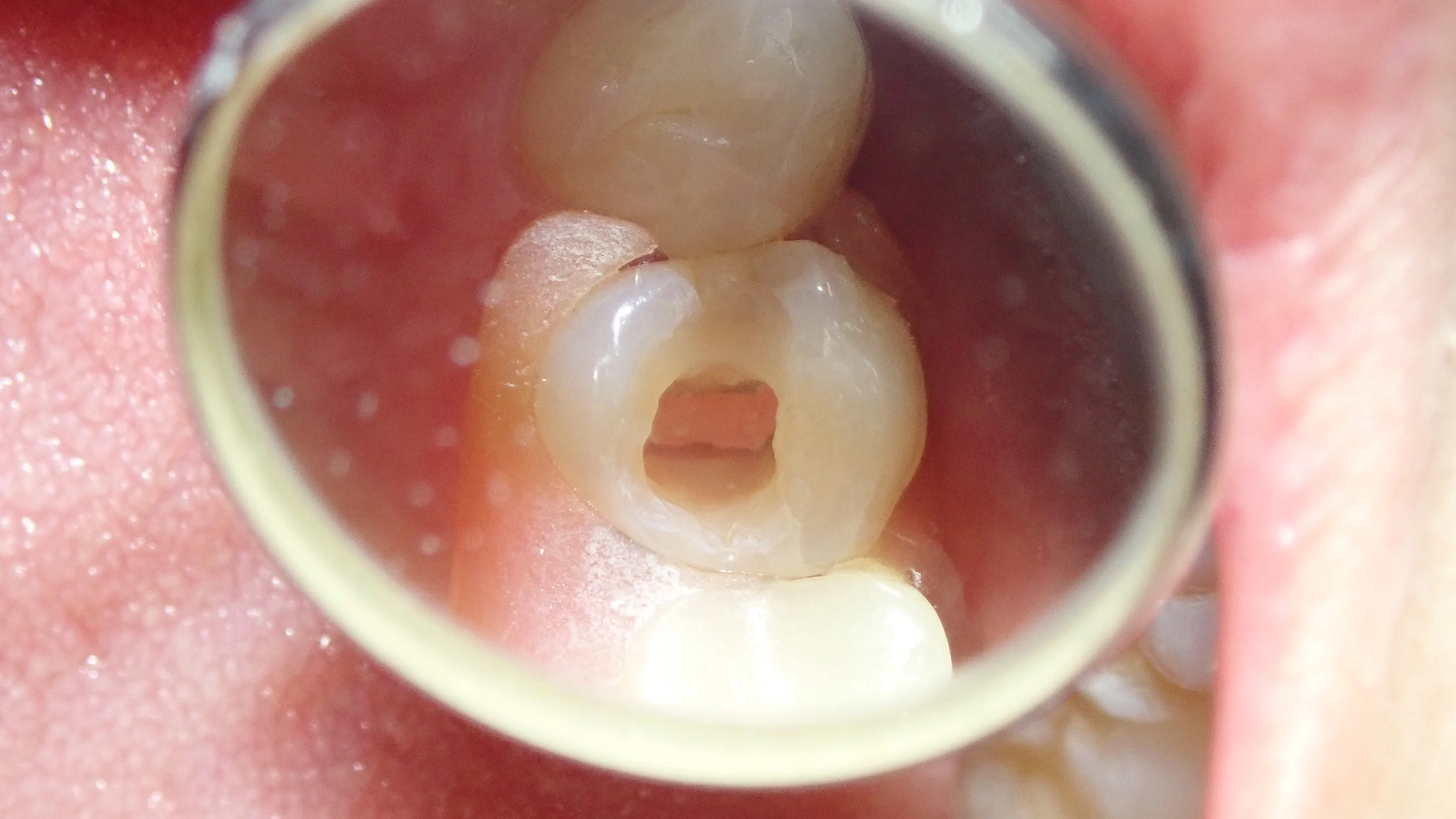 ダイレクトボンディング④|坂寄歯科医院(取手市藤代) - 画像6